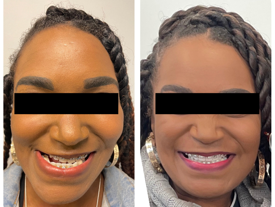 Before and after treatment at Philadelphia Oral & Maxillofacial Surgery