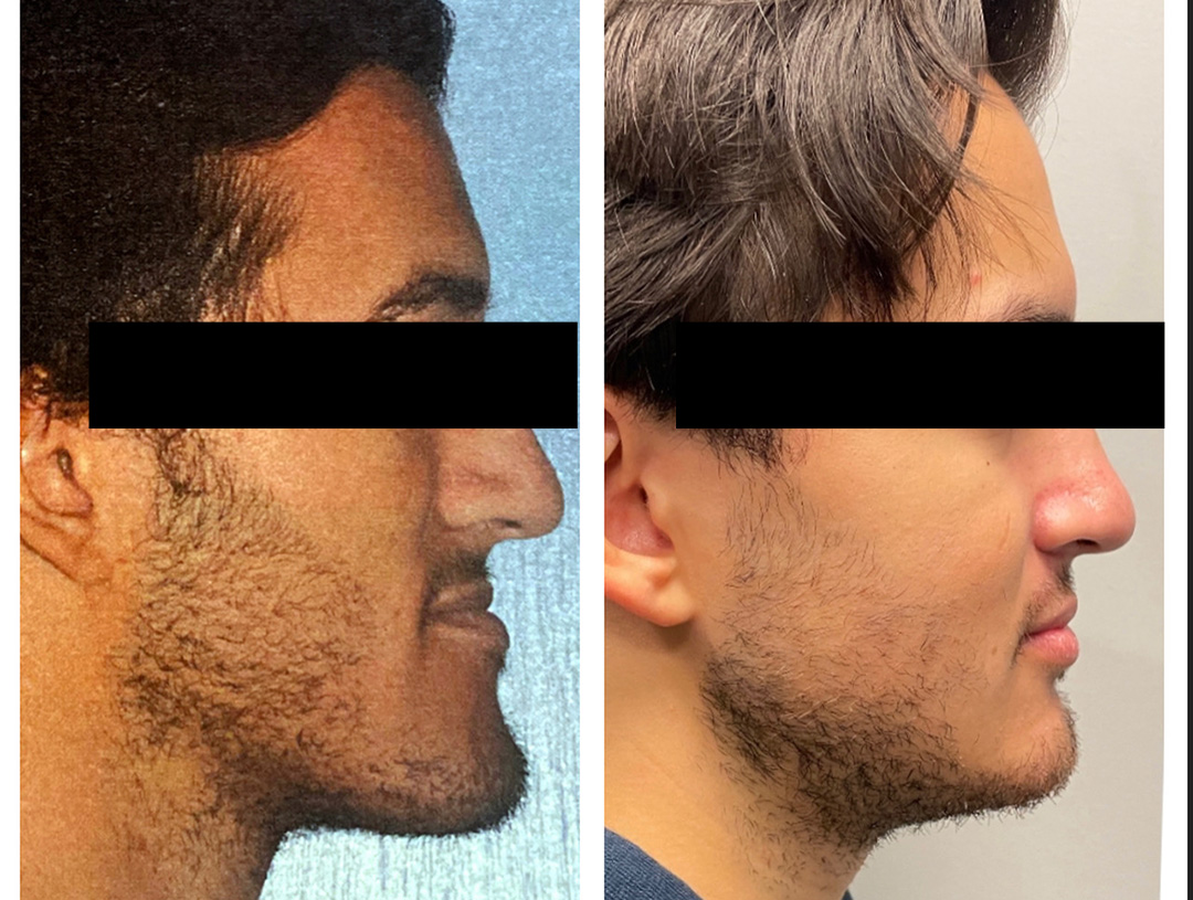 Before and after treatment at Philadelphia Oral & Maxillofacial Surgery