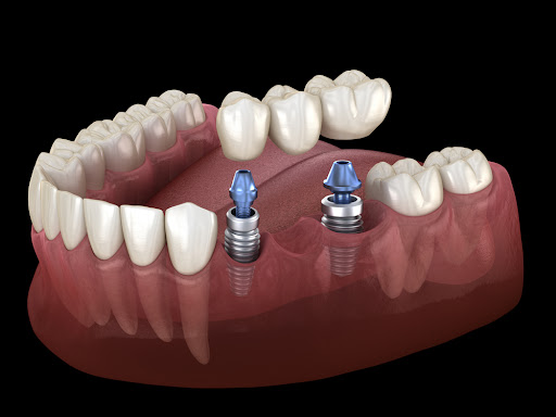 Dental Implants - Implant supported Bridge
